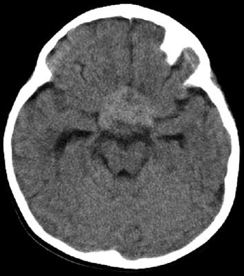 Optic Pathway–Hypothalamic Glioma Apoplexy: A Report of Two Cases and Systematic Review of the Literature